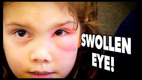 Toddlers Swollen Eyes 2