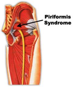 It's below the lowest part of the low back, but it often feels like low back pain. Piriformis Syndrome - Adolescent Hip Pain