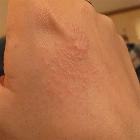 Pregnancy Skin I Got This Rash About A Week Ago 14 And 3 Now Itll
