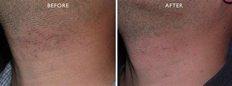 Pseudofolliculitis Barbae Advanced Skin Care Laser And Body Contouring