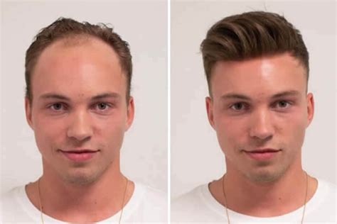 About men's hair replacement