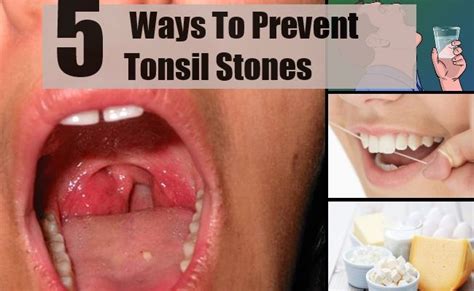 Tonsillensteine Tonsillolithen Symptome Ursachen Behandlung