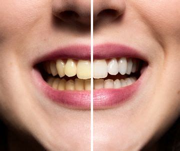 Anything you're able to get off with a toothpick you can get off with a brush. 9 Tips for Removing Tartar & Plaque from Teeth at Home ...