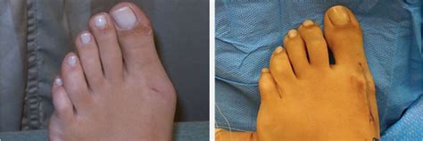 What Happens During Bunion Surgery Dallas Podiatry Works