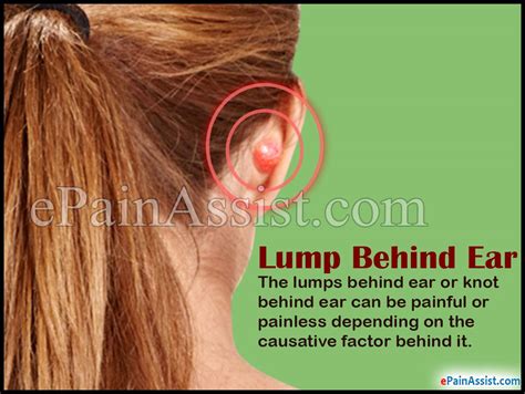 Lump Behind Ear Or Knot Behind Earcausestreatmentdiagnosis