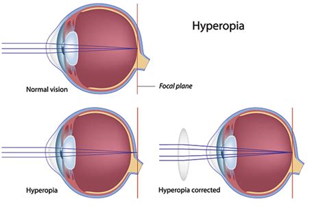 Hyperopiafarsightednesssymptomscauses And Treatment How To Relief