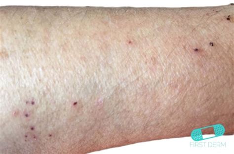 What Causes Small Itchy Bumps On Skin Reilly Thardle