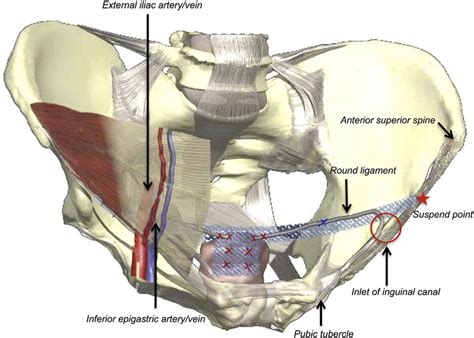 Schematic Representation Depicting Laparoscopic Inguinal Ligament