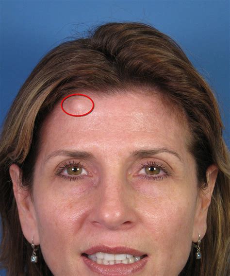 Forehead Reconstruction Facial Plastic Surgery In San Diego By Dr John