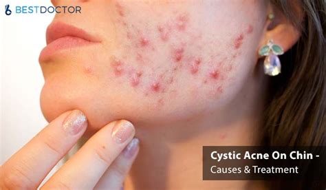 Cystic Acne On Chin Causes And Treatment