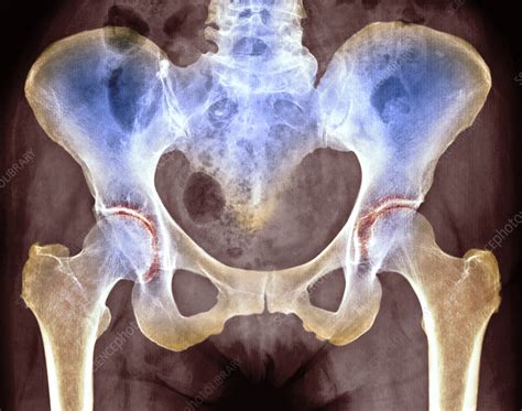 Osteoarthritis Of Hip Joints X Ray Stock Image M1100665 Science
