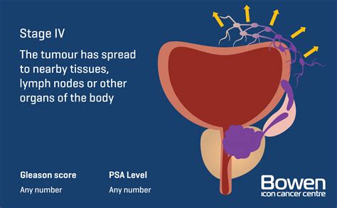 What Is Prostate Cancer Prostate Cancer Explained Bowen Icon Cancer Centre