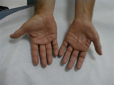 Muscle Atrophy Wikidoc