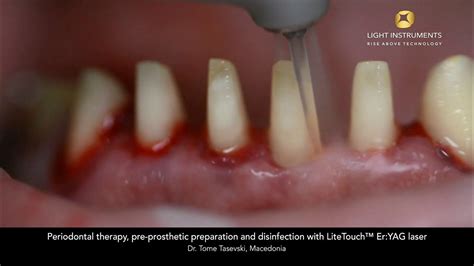 Periodontal Therapy Pre Prosthetic Preparation And Disinfection With