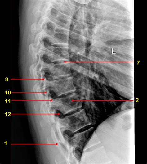 Thoracic Spine X Ray Labeled Cloudshareinfo