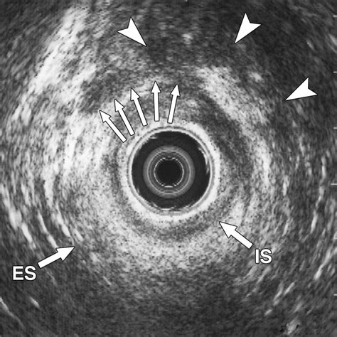 Cross Sectional Imaging Of The Anal Sphincter In Fecal Incontinence Ajr