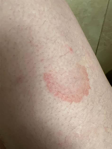 23m Reddish And Circular Rash On Top Of My Thigh No Painitchiness