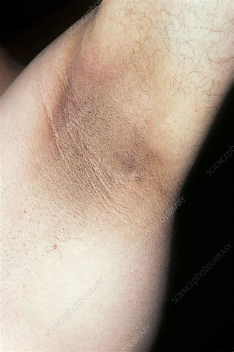Acanthosis Nigricans In The Armpit Stock Image C0131055 Science