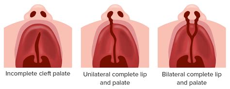Cleft Lip And Cleft Palate Concise Medical Knowledge