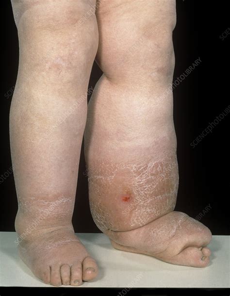 Lymphoedema Of The Legs Stock Image C0235718 Science Photo Library