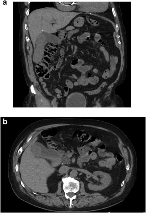Ct Abdomenpelvis Without Contrast A Coronal And B Axial Slices