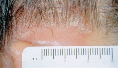308 Nm Excimer Laser For The Treatment Of Scalp Psoriasis Dermatology
