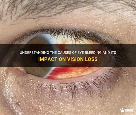 Understanding The Causes Of Eye Bleeding And Its Impact On Vision Loss