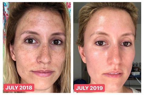 Tretinoin And Hydroquinone Before And After
