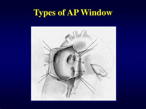 Ppt Aortopulmonary Window Powerpoint Presentation Free Download Id