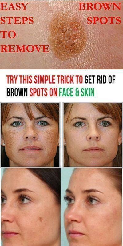 How To Get Rid Of Brown Spots On Face And Hands Brown Spots On Face