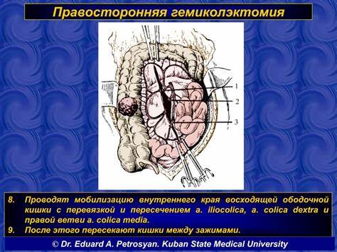 Диета при гемиколэктомия