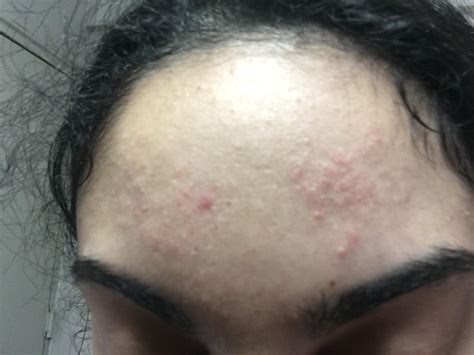 Forehead Rash Or Acne General Acne Discussion Acne Org Forum
