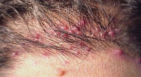 What Is Folliculitis Folliculitis Is A Common Skin Condition In Which
