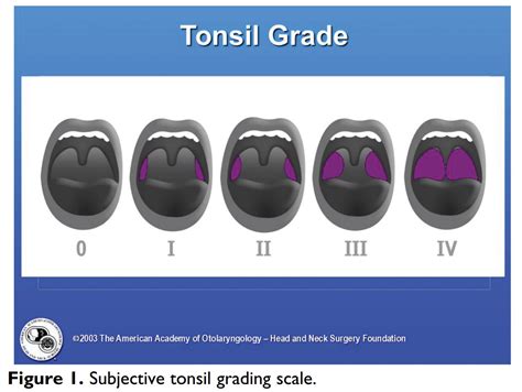 Tonsillitis Grading