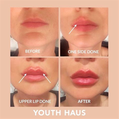 Before And After Lip Injections Botox And Injectables — Youth Haus