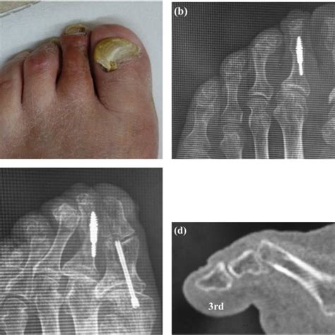 Clinical Photograph Showing Callus Formation Over The Third And Fourth