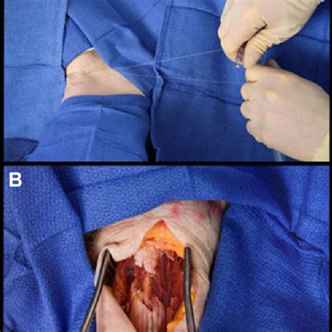 Left Adductor Longus Tendon With The Cutting Wire Entering And Exiting