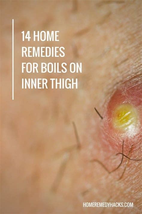 Infected Ingrown Hair Inner Thigh In 2020 Home Remedy For Boils Home