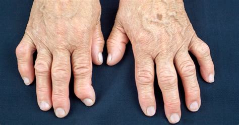 Artrite O Que é Sintomas Diagnóstico E Tratamento Tua Saúde