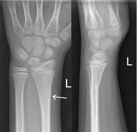 Fractures Distal Forearm Or Wrist