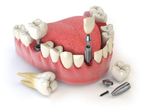 Implantes Dentales De Titanio Dental Planet