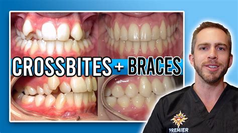Crossbite Braces Treatment Before And After Youtube