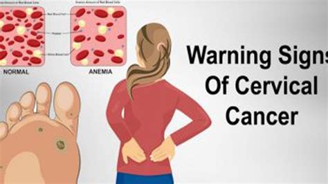 Warning Women Never Ignore These 7 Signs Of Cervical Cancer Youtube