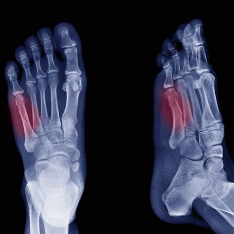 Foot Fracture Treatment Sport Orthopedics And Rehabilitation