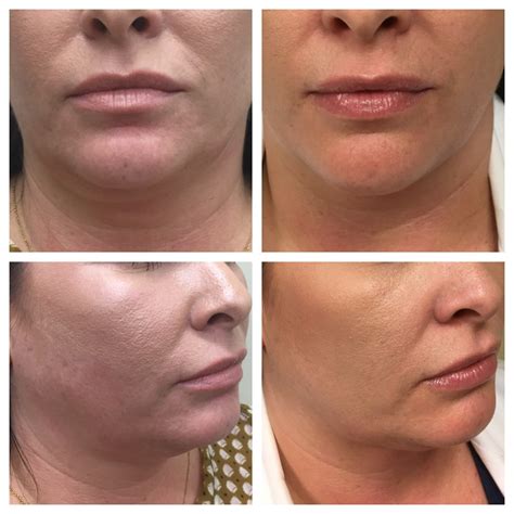 Kybella Before And After Southeastern Dermatology