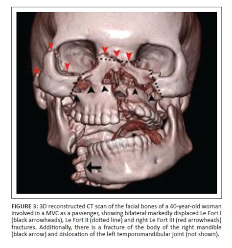 Facial Fractures Facial Trauma Facial Reconstruction Mandible Fractures