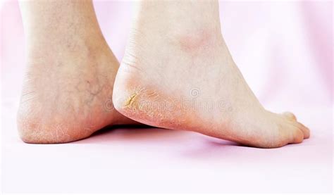 Legs Female With Dry Cracked Skin On A Pink Background Stock Photo