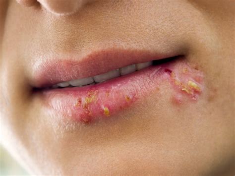 How To Treat Fever Blisters On Your Lips