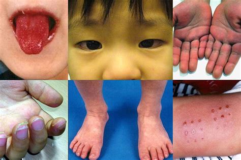 Kawasaki Like Disease Afflicting Young Children And Teens After