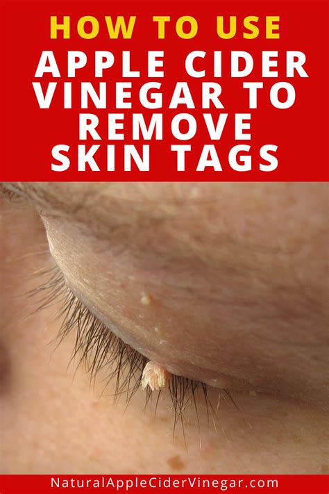 how does apple cider vinegar help remove skin tags howotremvo